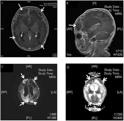 meningitis mri neurological bacterial gbs complications acute frontiersin infants young